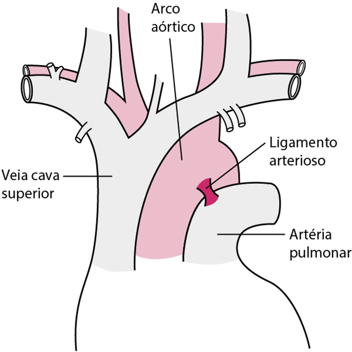 A maioria das rupturas parciais da aorta ocorre perto do ligamento arterial