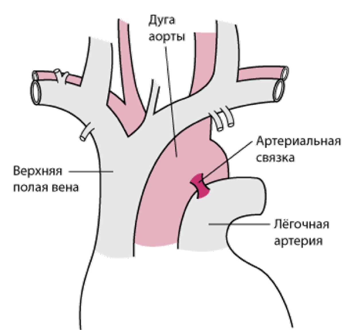 Большинство частичных разрывов аорты происходит в области артериальной связки