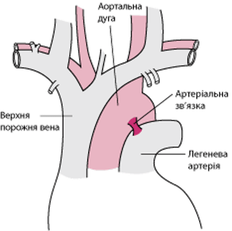 Більшість часткових розривів аорти виникають біля артеріальної зв'язки.