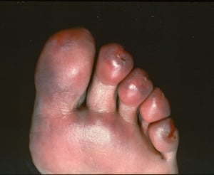 Frieira (eritema pérnio, artelhos)