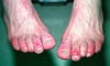 Chilblains (Toes)