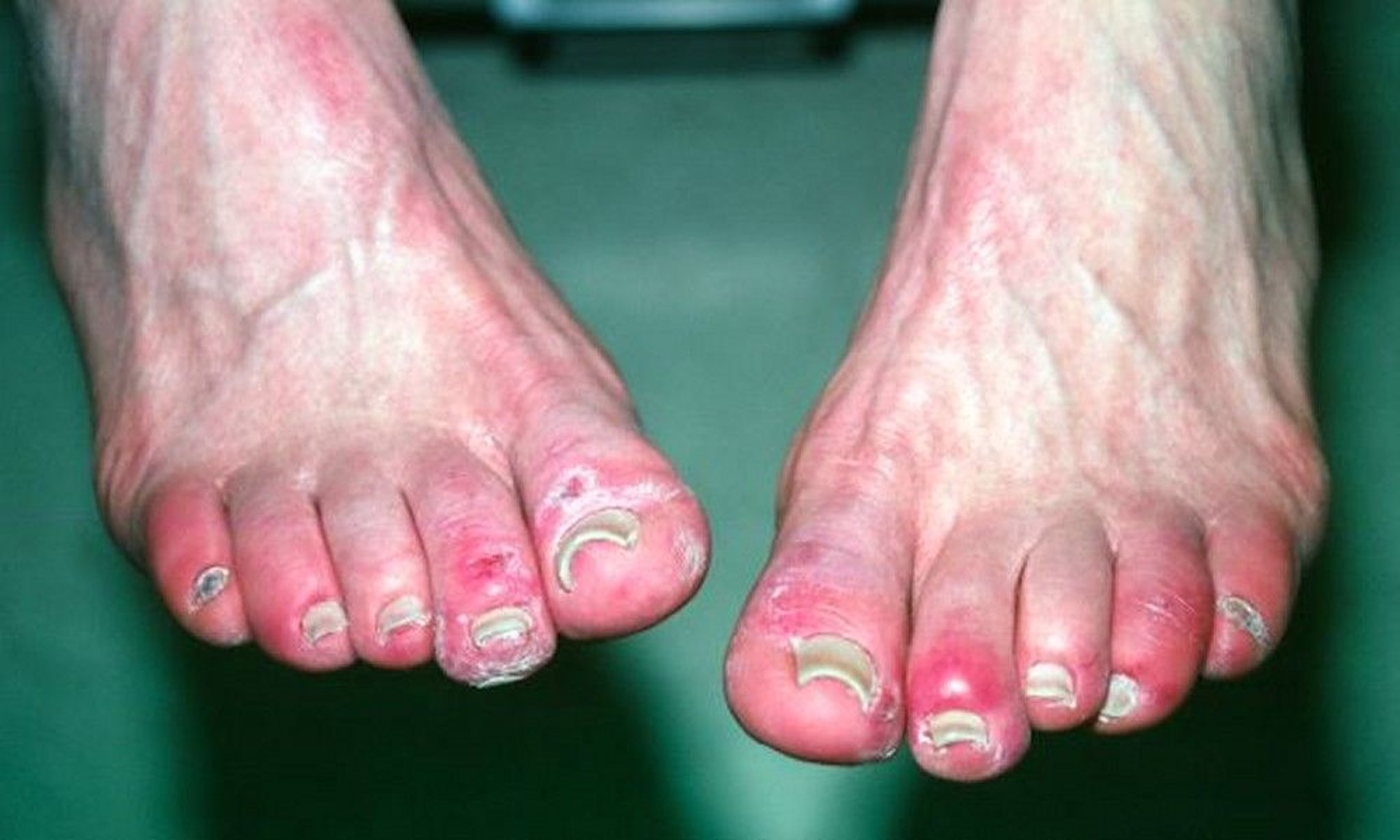Chilblains (Toes)