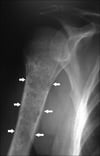 Condrosarcoma del húmero