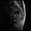 Chordoma