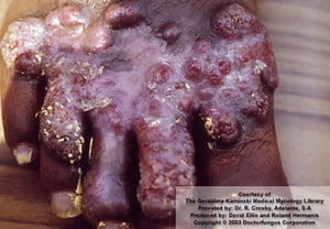 Cromoblastomicosis (crónica)