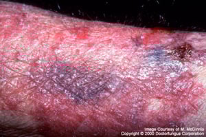 Cromoblastomicosis (temprana)