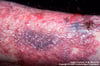 Nấm sâu Chromomycosis (giai đoạn đầu)