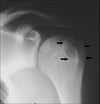Chondroblastoma