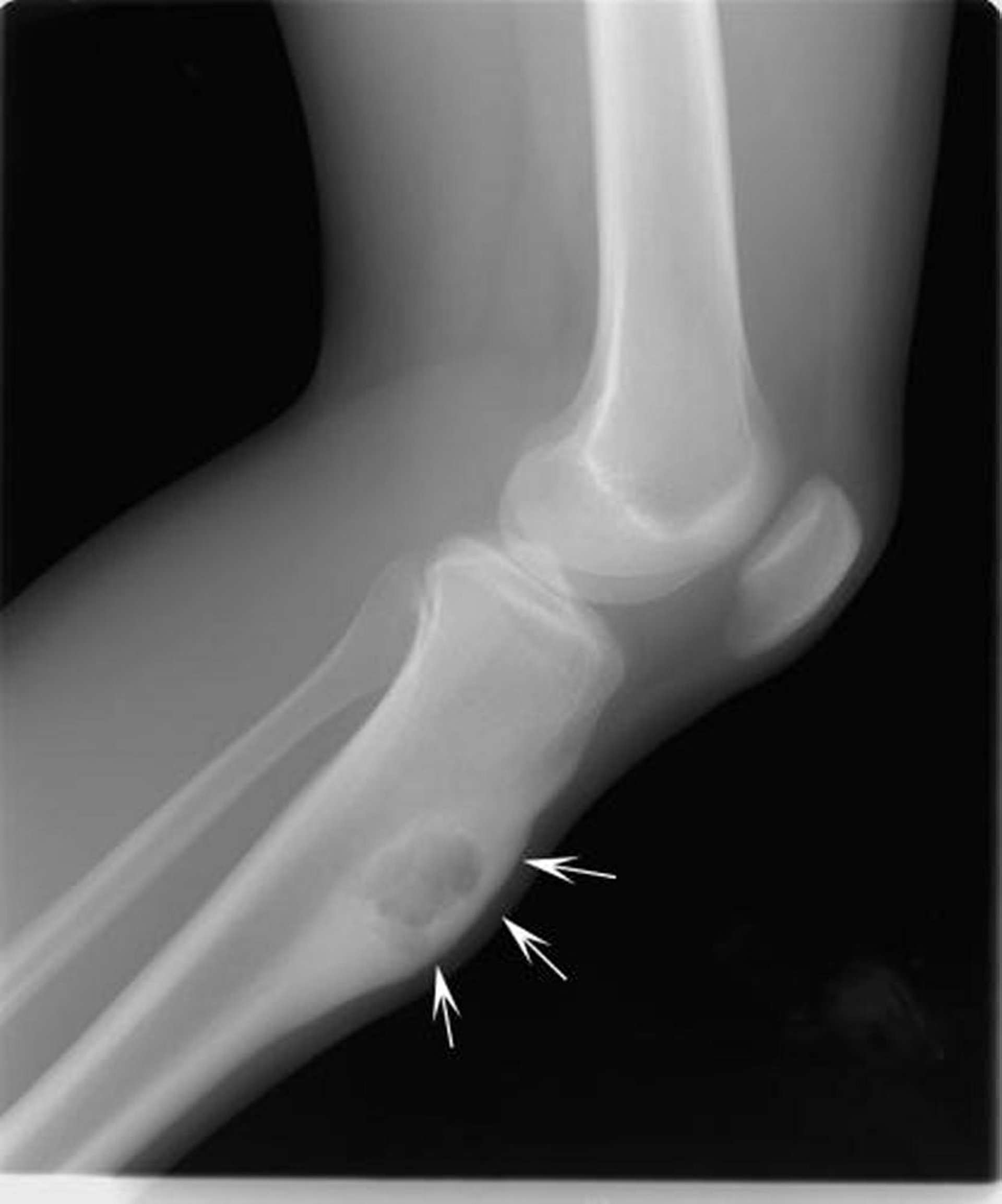 Chondromyxoid-Fibrom