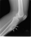 Fibroma condromixoide