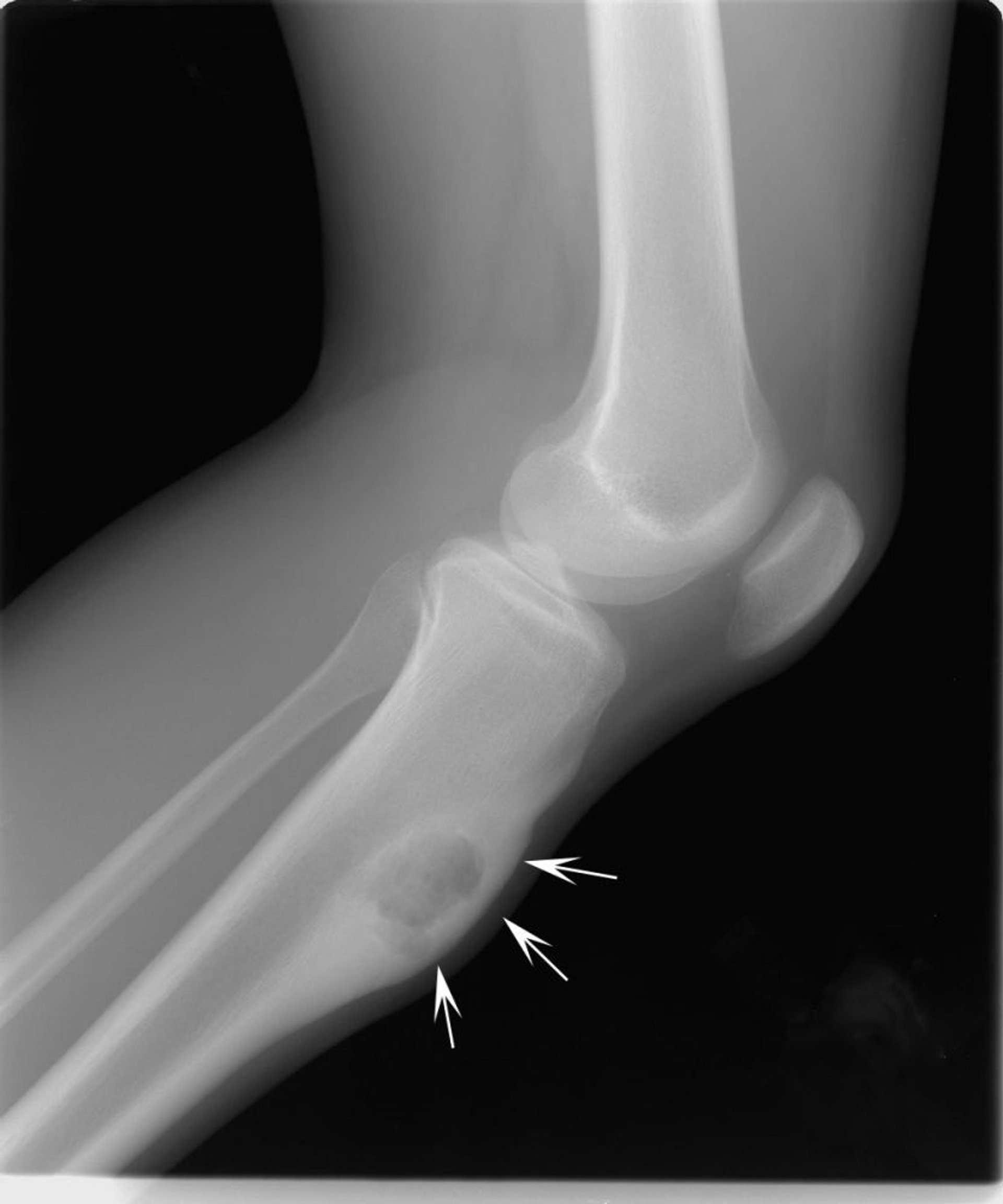 Хондромиксоидная фиброма