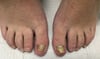 Chronic Retronychia (Big Toes)