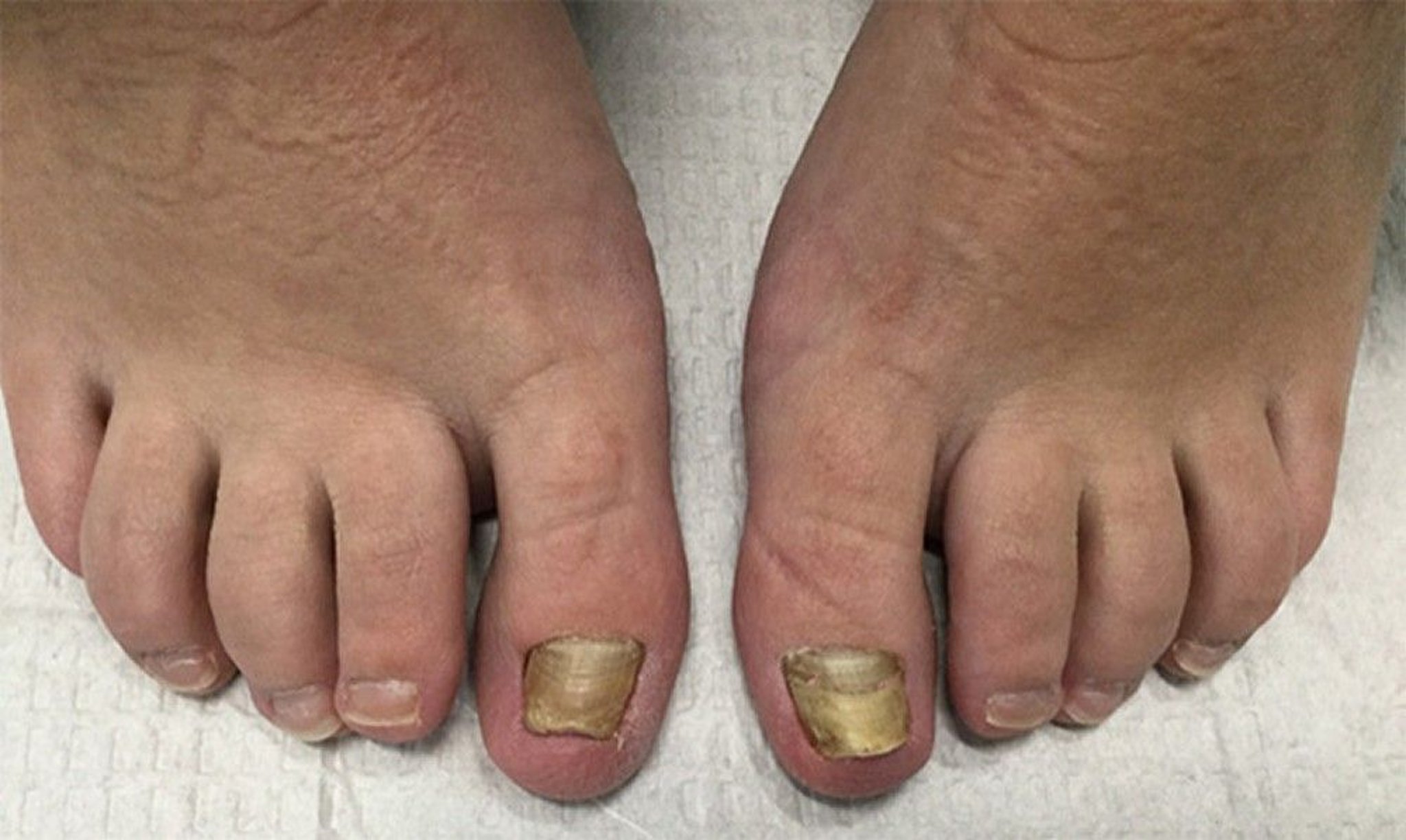 Chronic Retronychia (Big Toes)