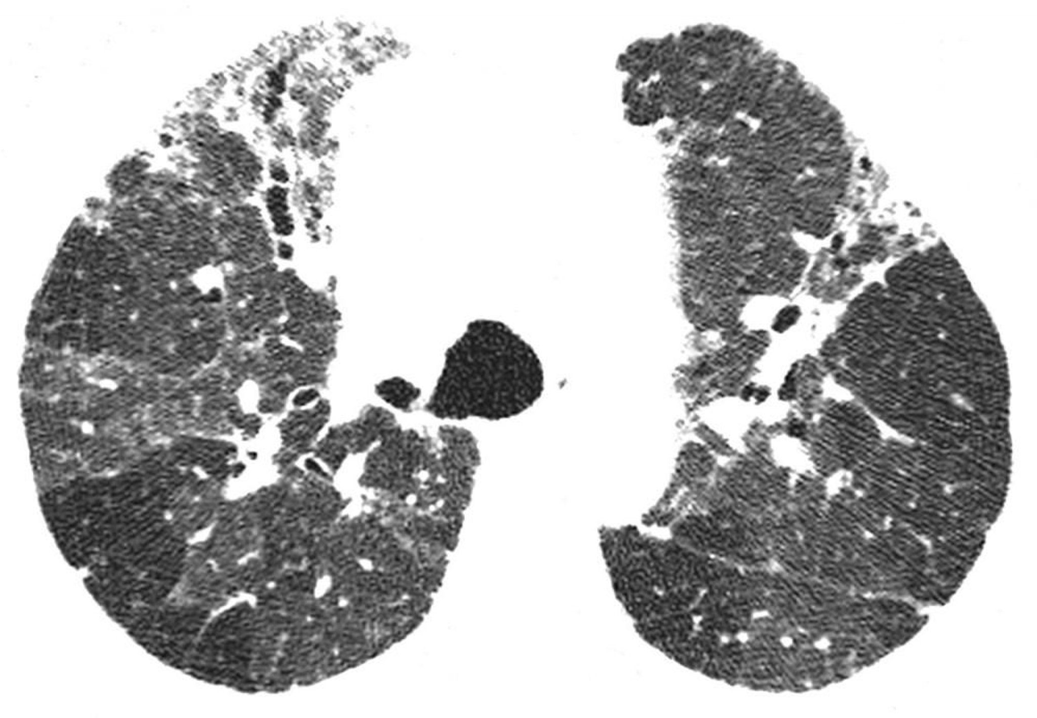 Neumonitis crónica por hipersensibilidad