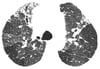 Pneumopathie d'hypersensibilité chronique