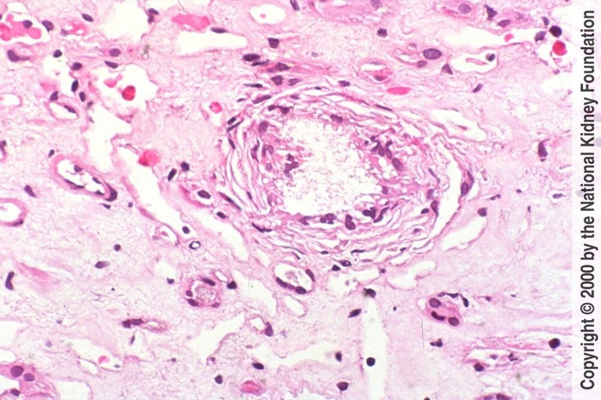Chronic Urate Nephropathy