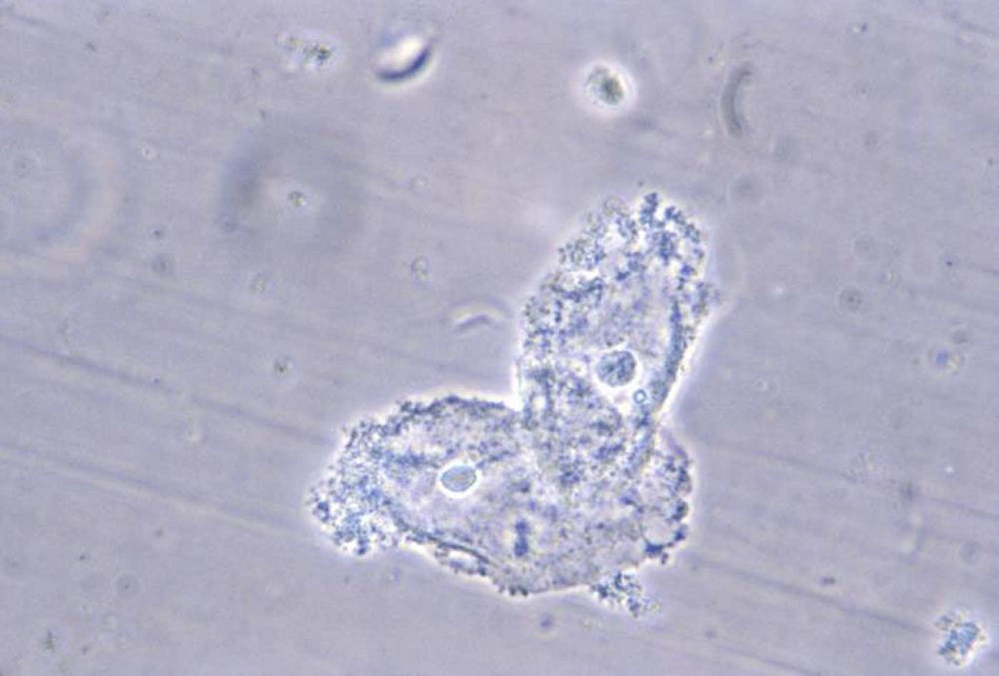 Cellules à inclusions (bactéries adhérentes aux cellules épithéliales masquant les membranes cellulaires)