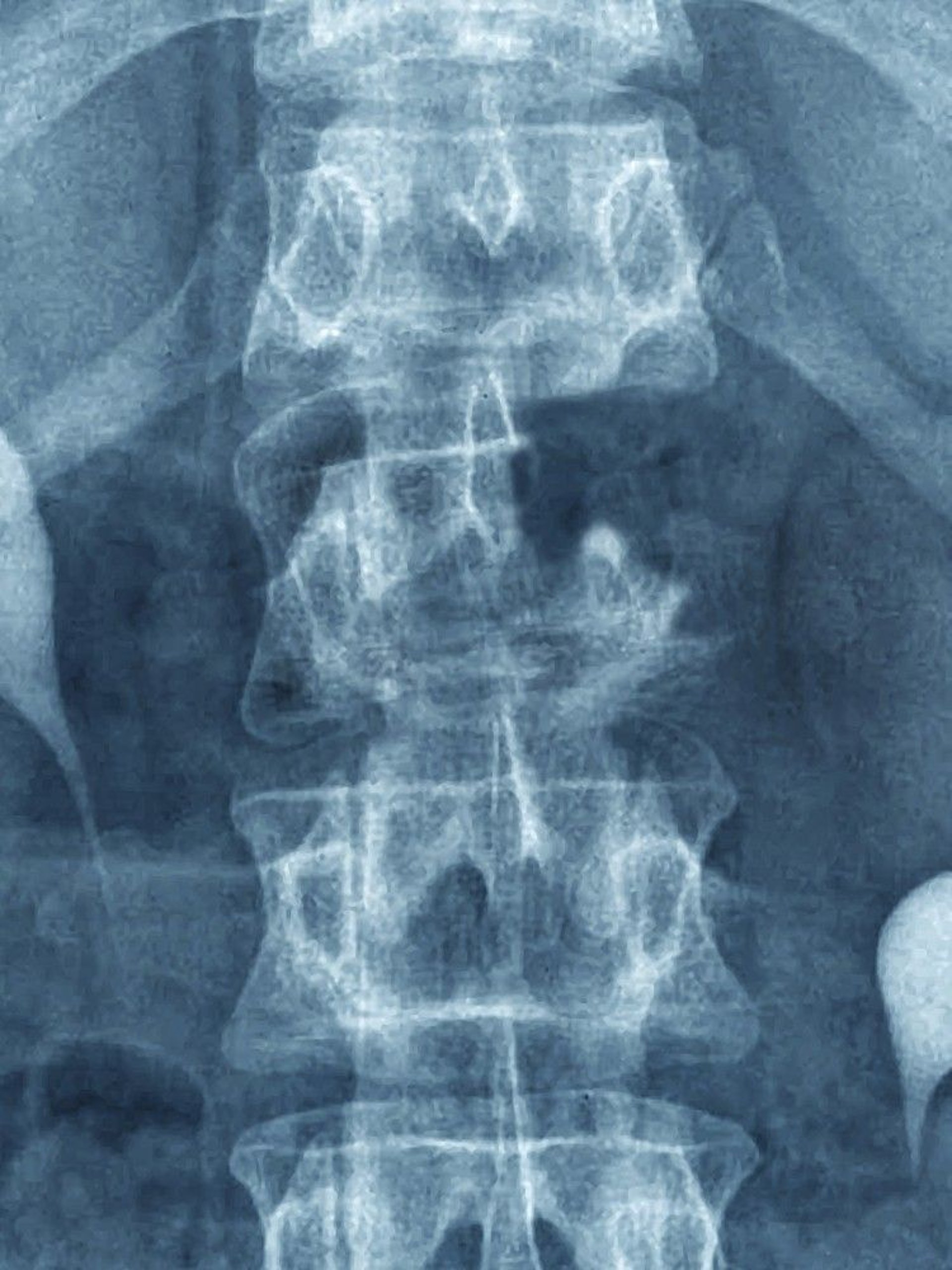 Metastatic Bone Cancer