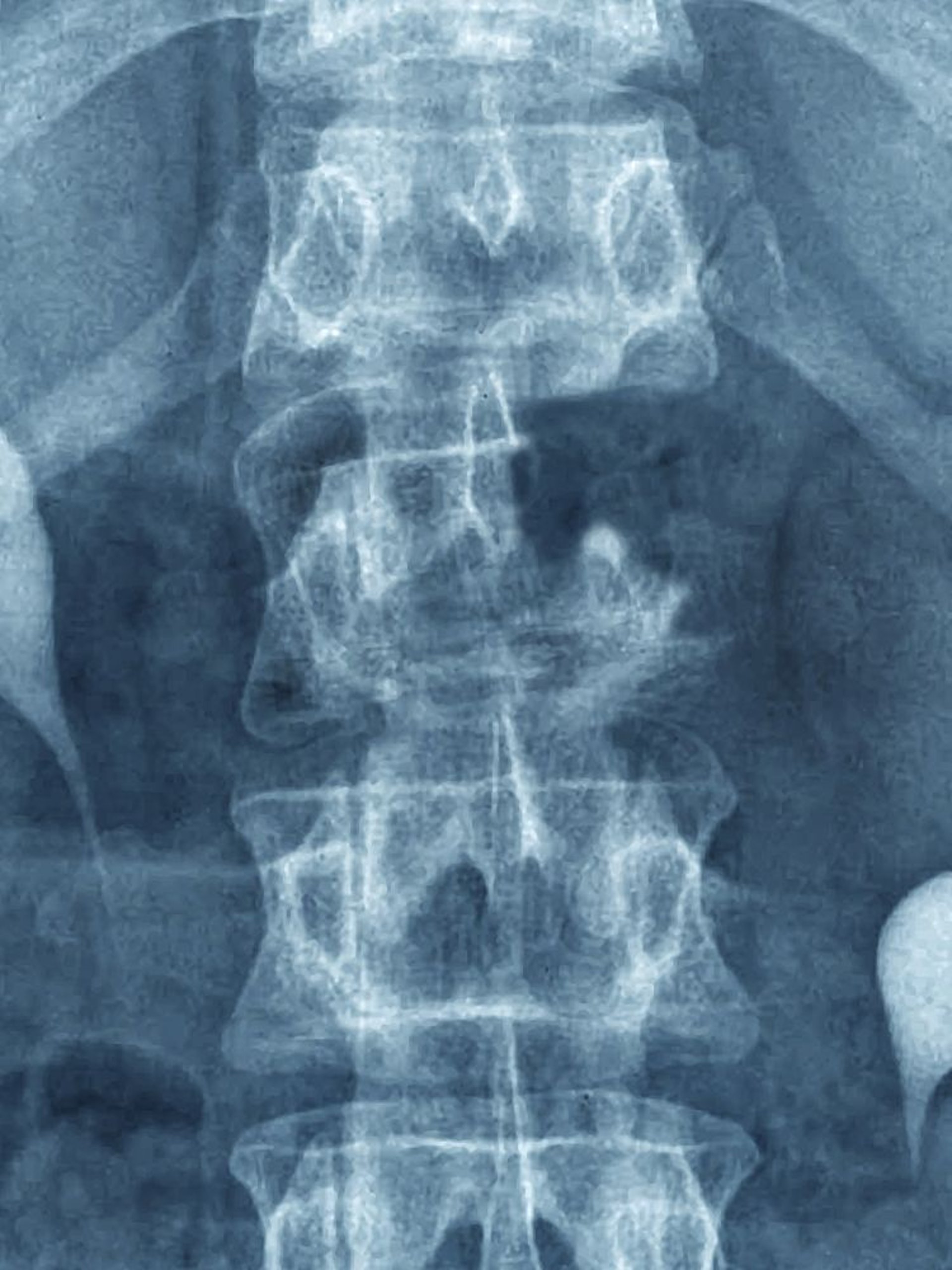 Cáncer óseo metastásico