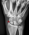 Fracture du scaphoïde carpien