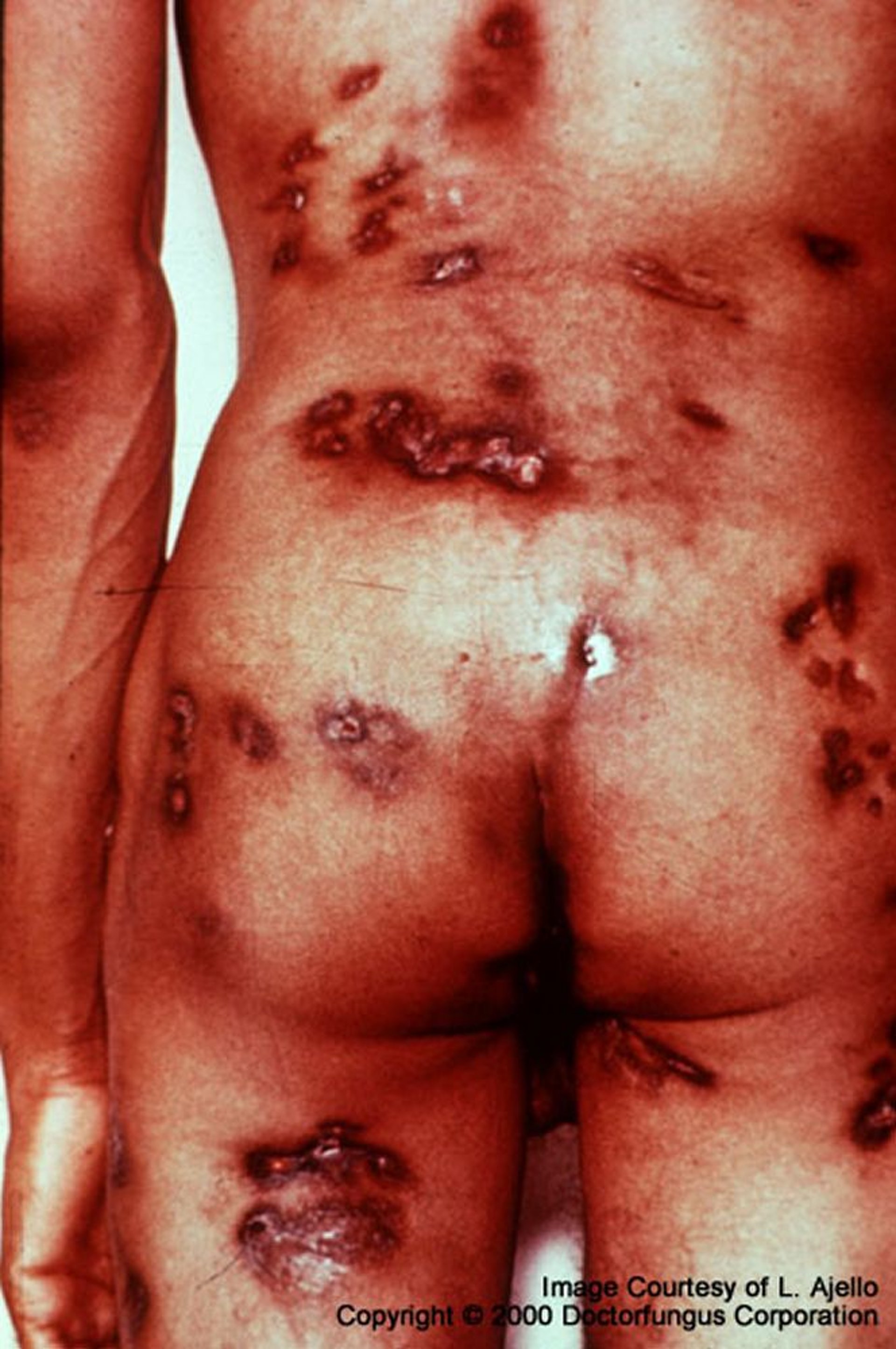 コクシジオイデス症—播種性（多発性病変）