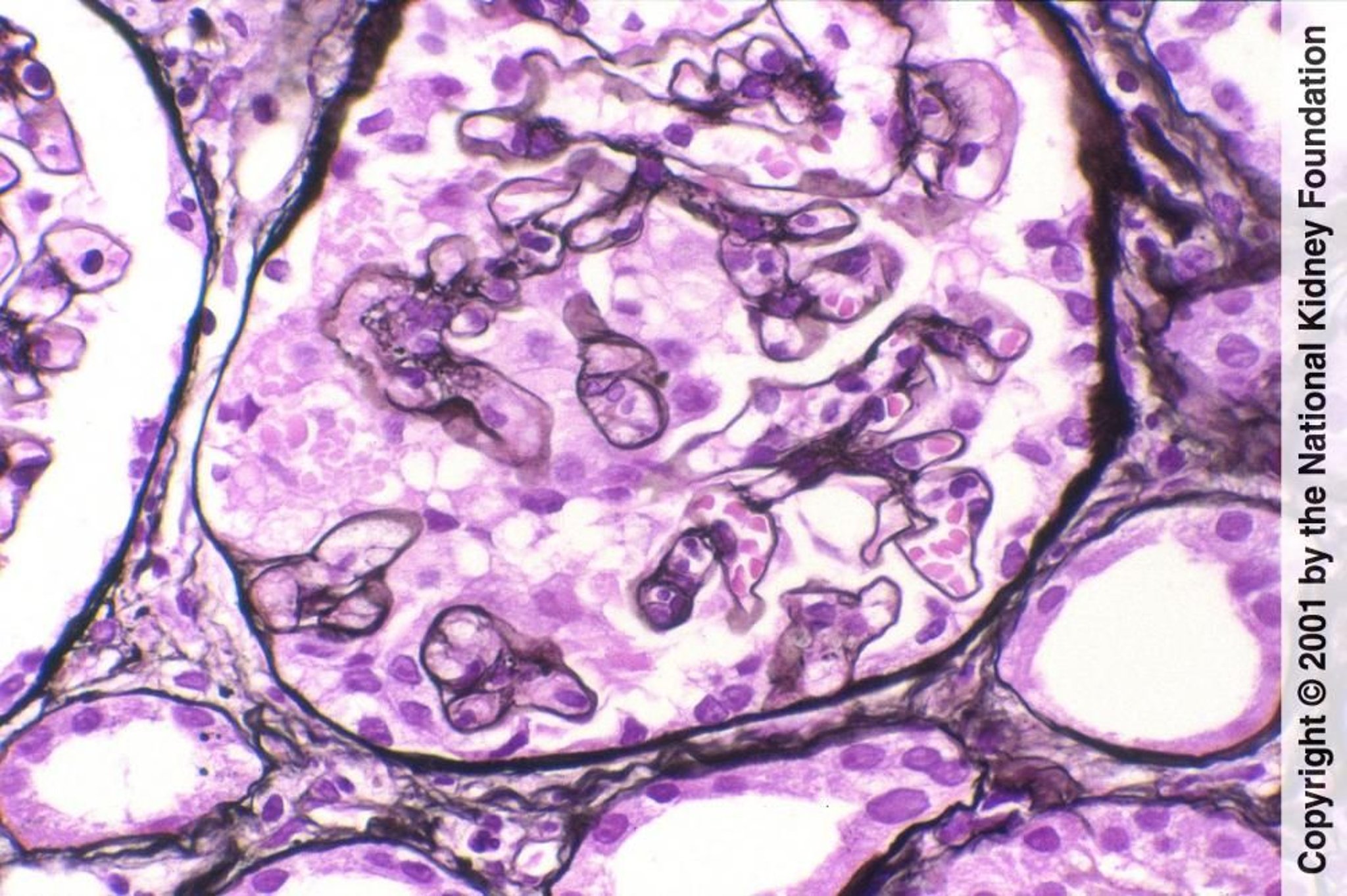 "collapsing" Glomerulopathie