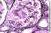 Collapsing Glomerulopathy