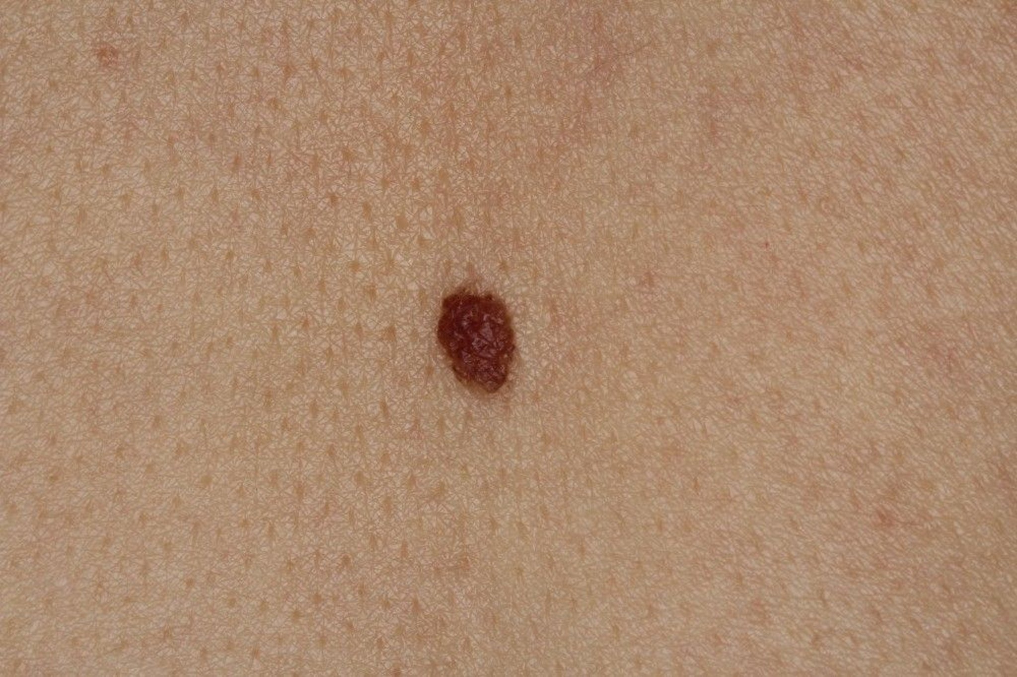 Compound Nevus