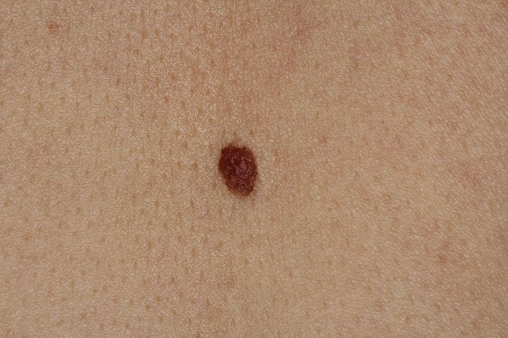 Складний невус