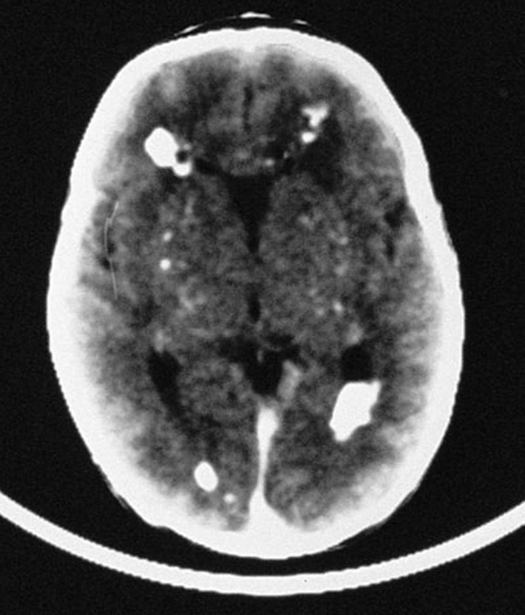 Infections congénitales et périnatales dues au cytomégalovirus (CMV ...