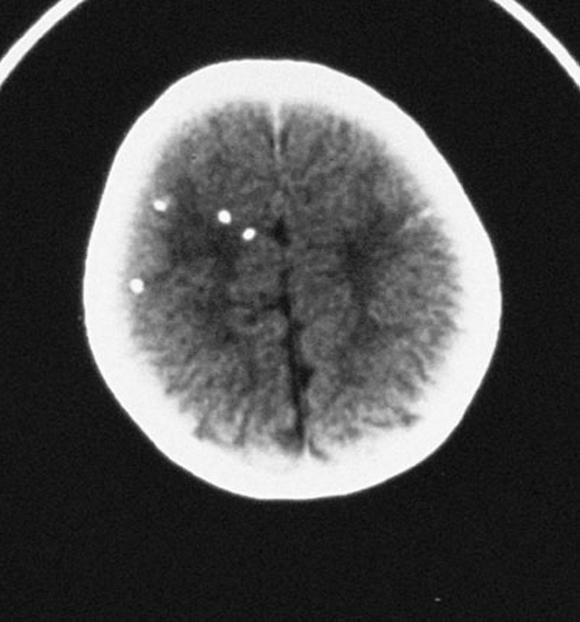 Congenital Toxoplasmosis
