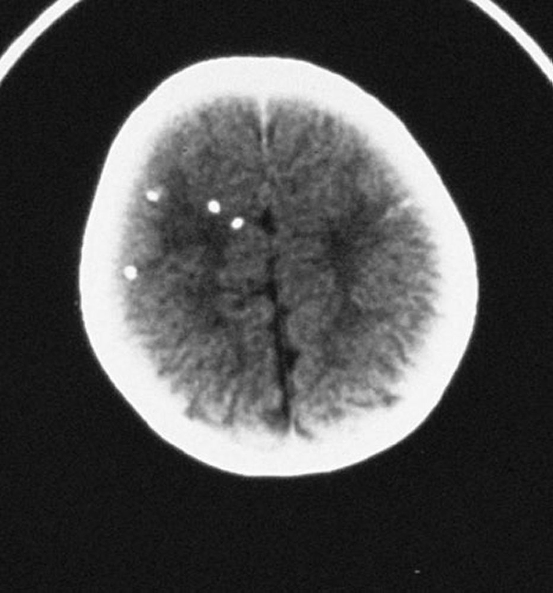 Toxoplasmosis congénita