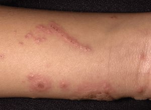 Dermatitis de contacto (alérgica)