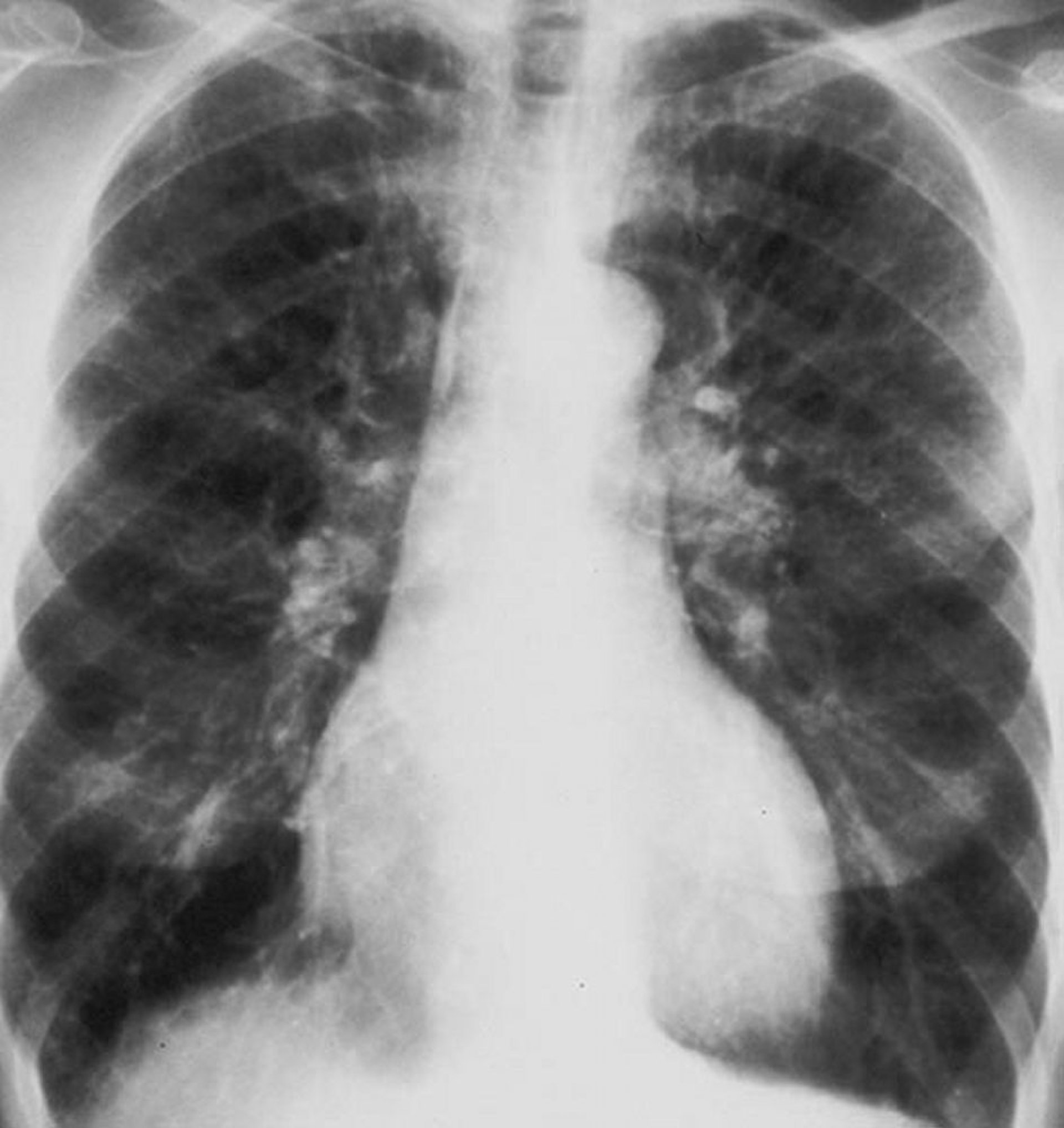 Enfermedad pulmonar obstructiva crónica (radiografía de tórax)