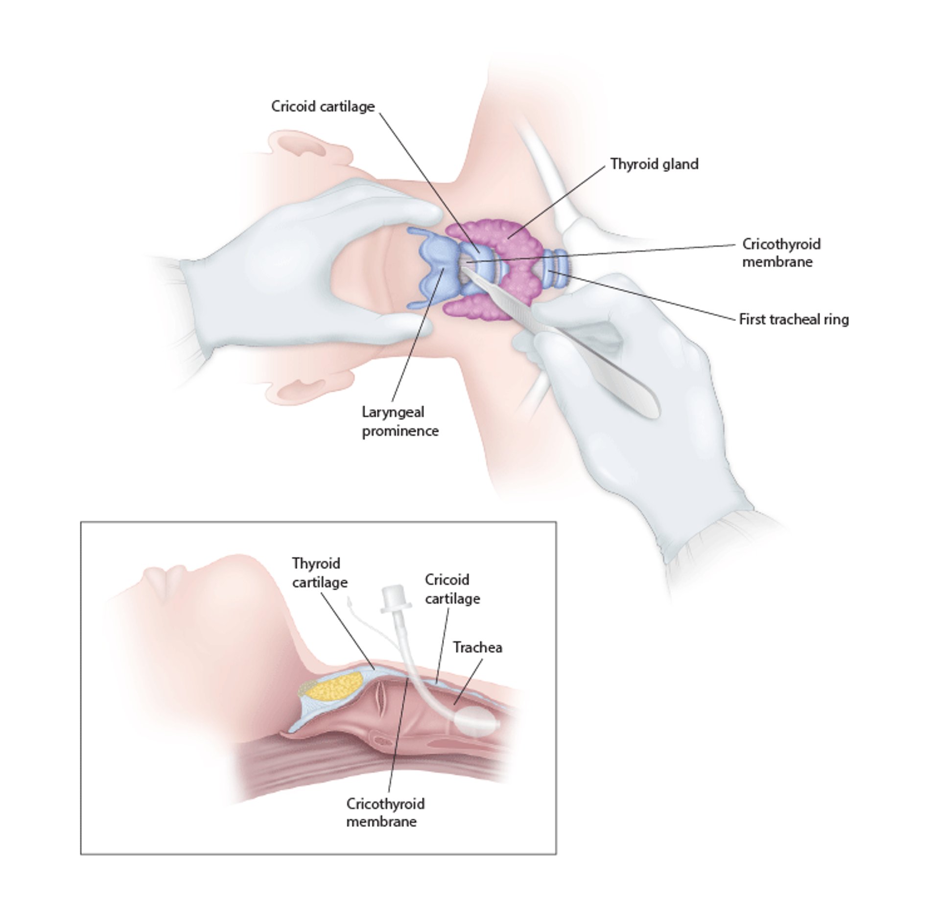 Cricothyrotomie d'urgence