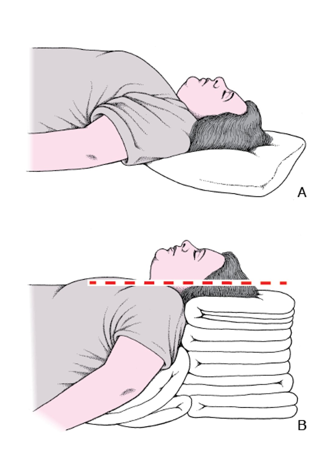 Head and Neck Positioning to Open the Airway: Sniffing Position