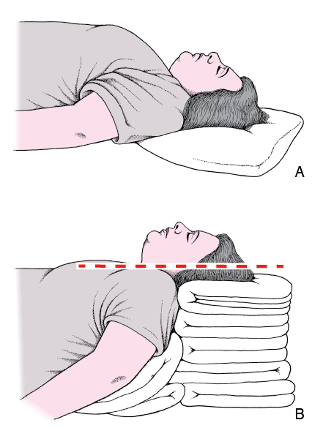 Posición de la cabeza y el cuello para abrir la vía aérea: posición de olfateo