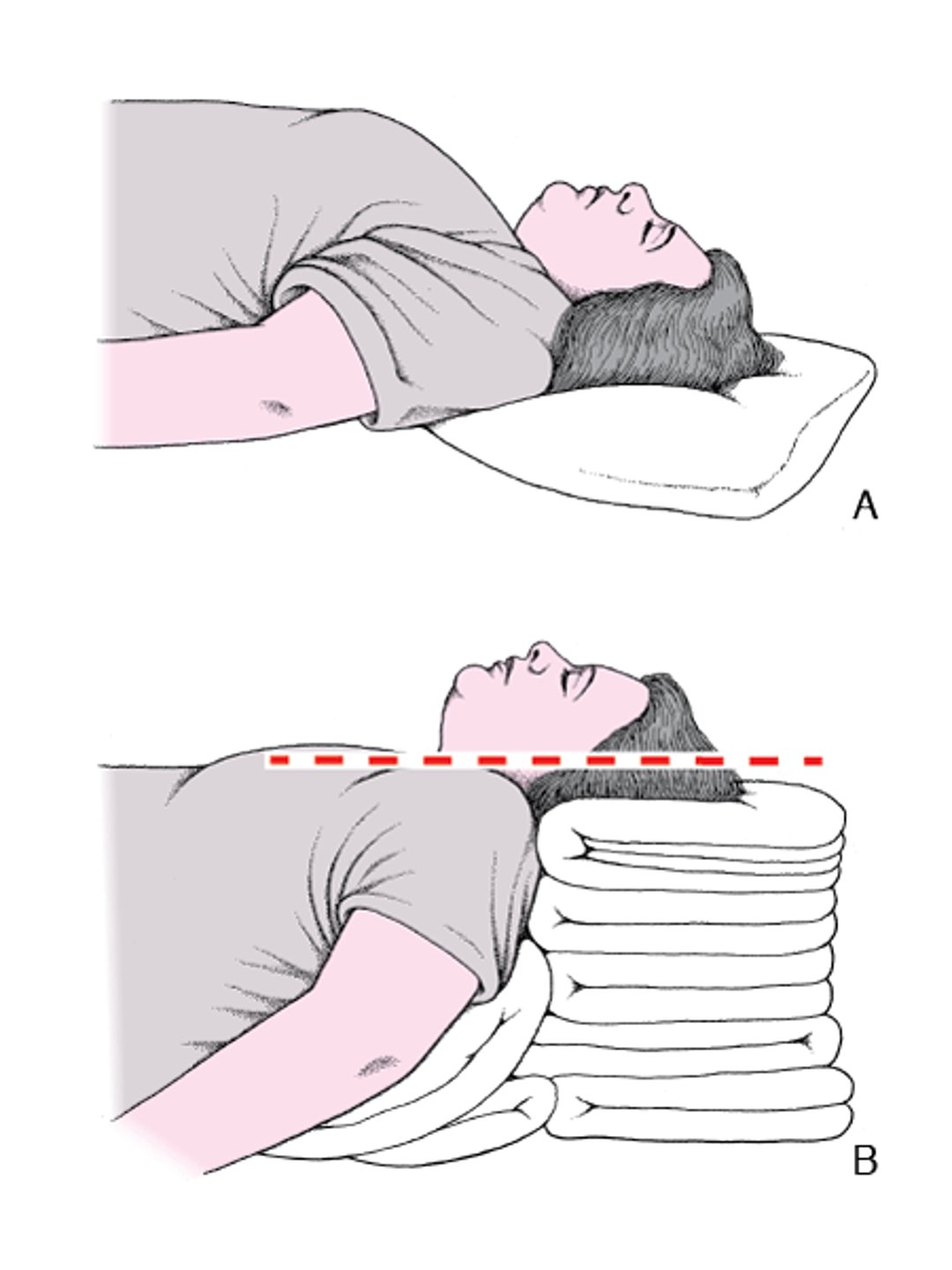 Positionnement de la tête et du cou pour dégager les voies respiratoires: tête surélevée en hyperextension ("Sniffing" position [position du renifleur])