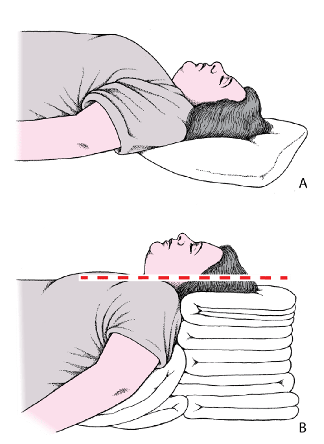 Head and Neck Positioning to Open the Airway