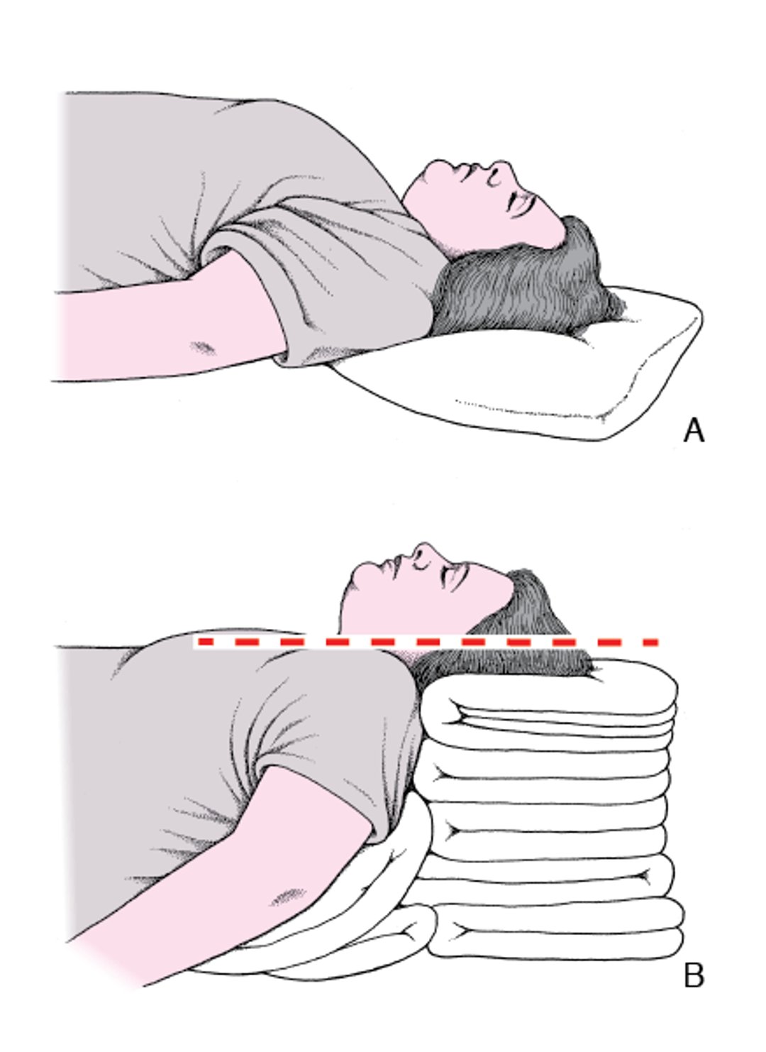 Head and Neck Positioning to Open the Airway