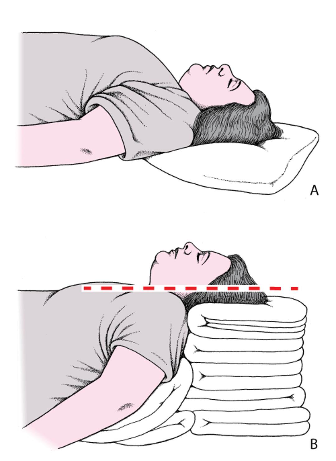 Head and neck positioning to open the airway
