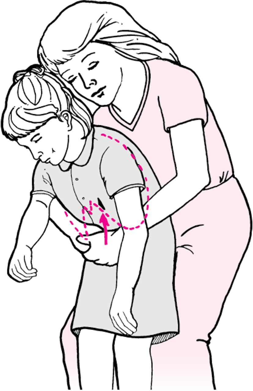 Compresiones abdominales con la víctima en posición de pie o sentada (consciente)