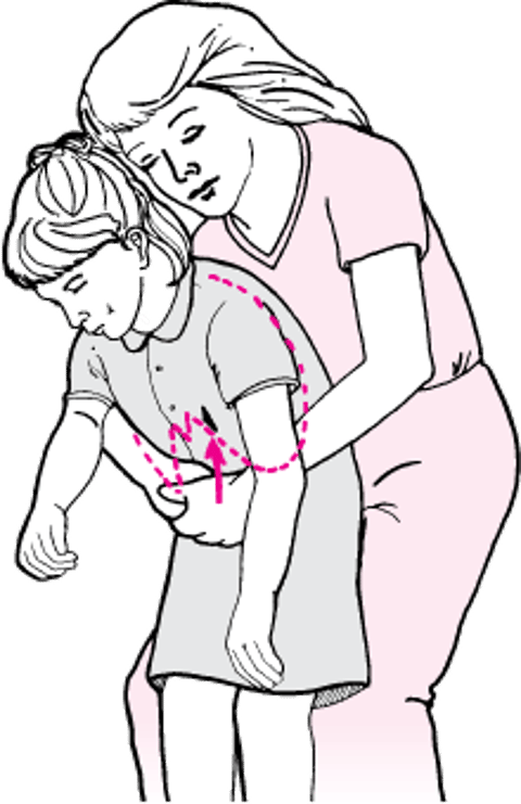 立位または座位の患者での腹部突き上げ法（意識がある場合）