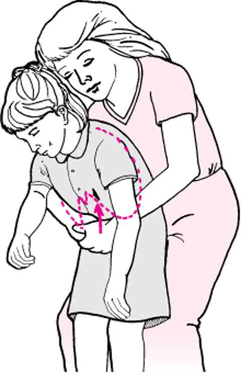 Прием Хеймлиха в положении пациента сидя и стоя (пострадавший в сознании)