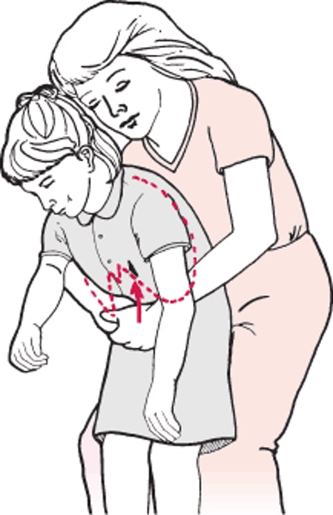 Đẩy bụng khi nạn nhân đứng hoặc ngồi (tỉnh táo)