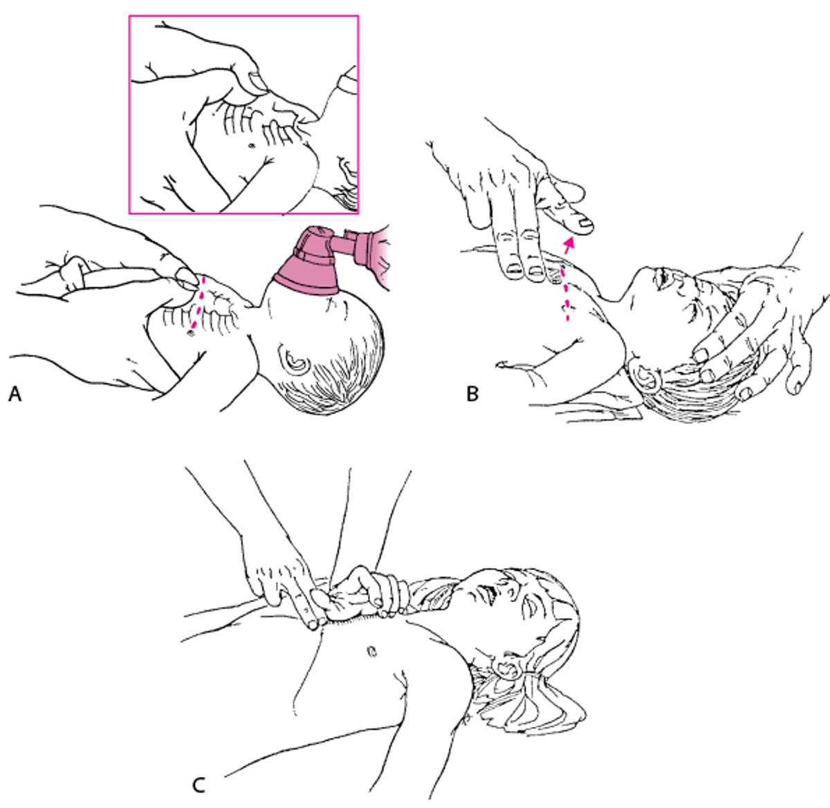 Chest Compression in Infants and Children