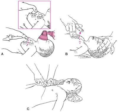 Compression thoracique chez les nourrissons et les enfants