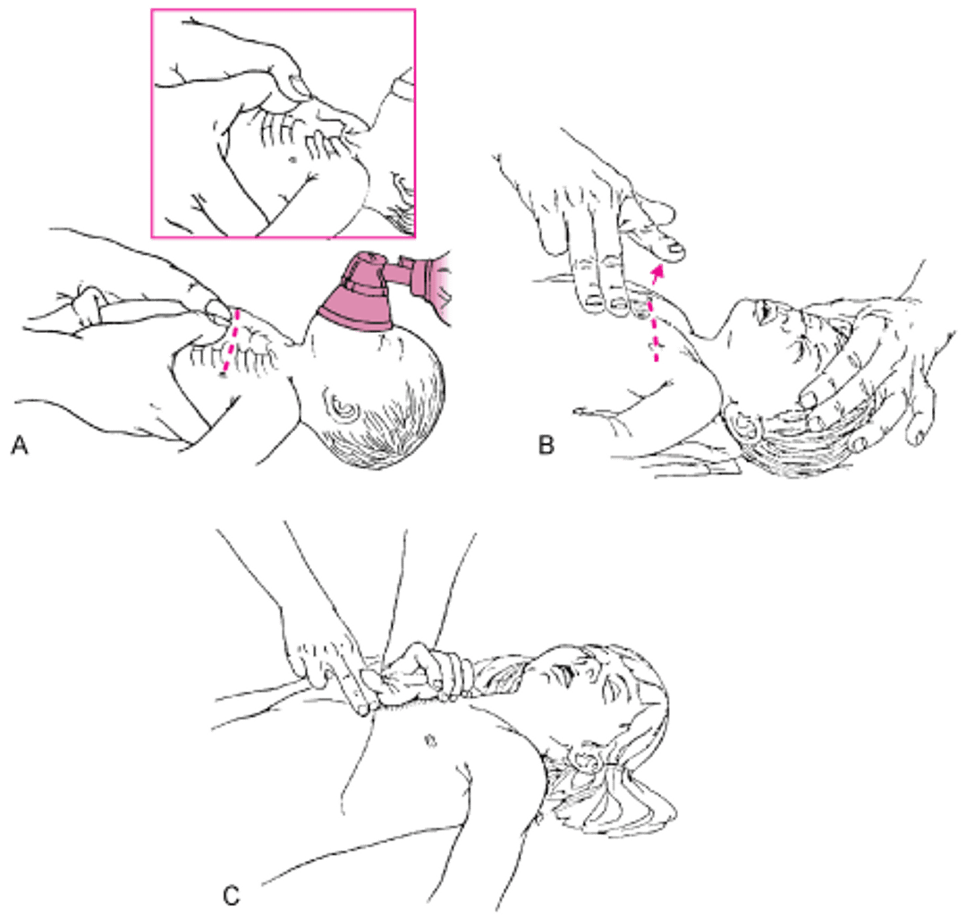 乳児および小児における胸骨圧迫