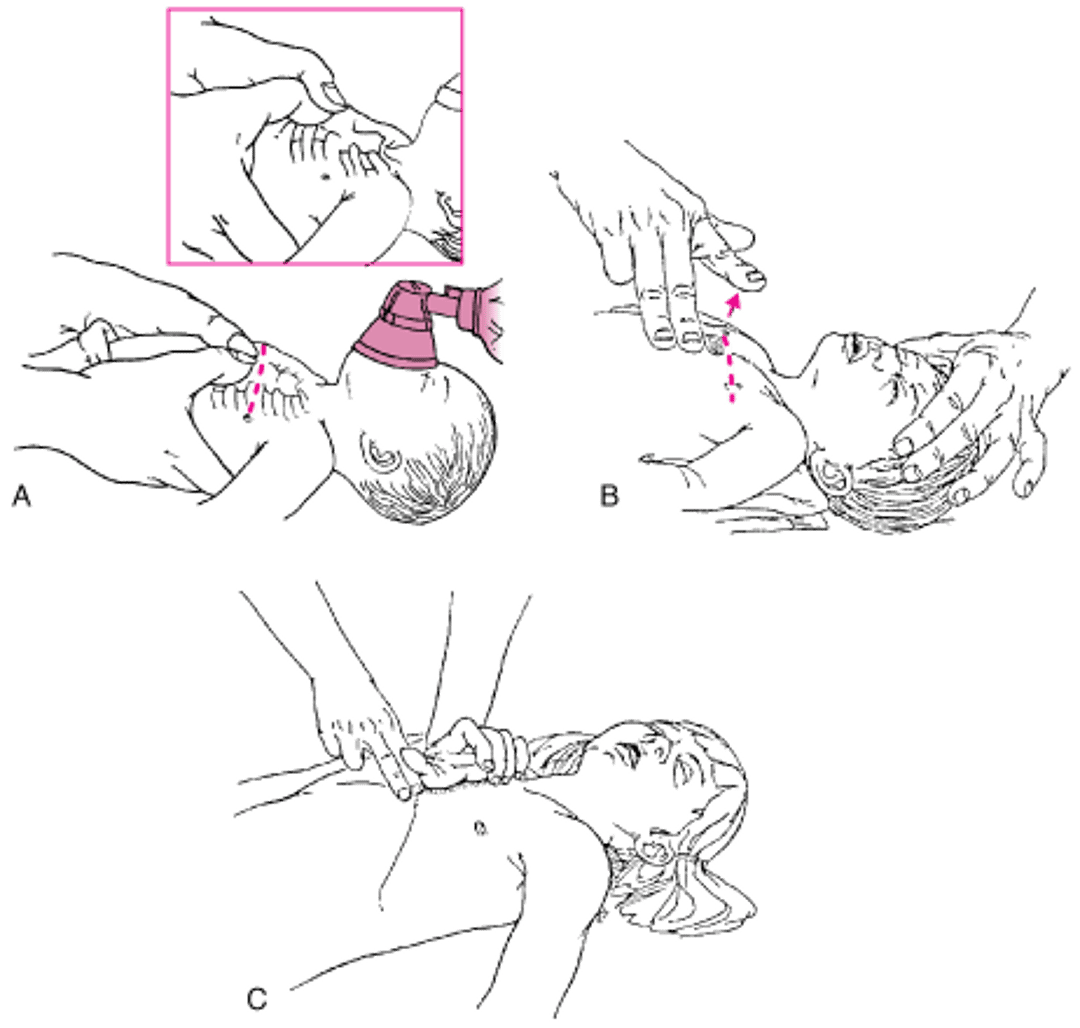 Компрессия грудной клетки у младенцев и детей.