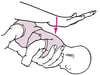 Back Blows—Infant